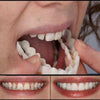 Lente de Contato Dental Removível Inferior e Superior– Resina Tooth